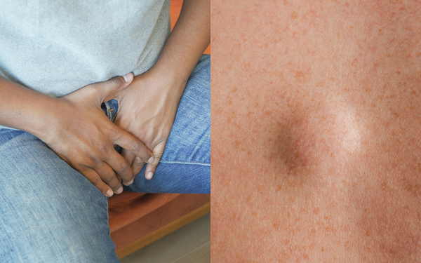 à esquerda, imagem aproximada de um homem com as mãos na virilha; à direita, um lipoma