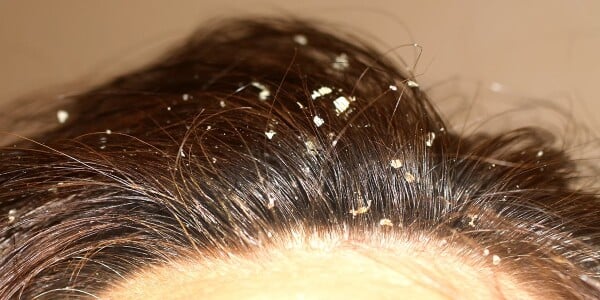 pessoa com caspa no cabelo