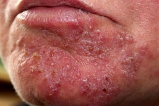 Foliculite no rosto - Foto: Shutterstock