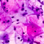 HPV