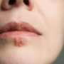 Herpes simples