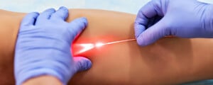 Escleroterapia